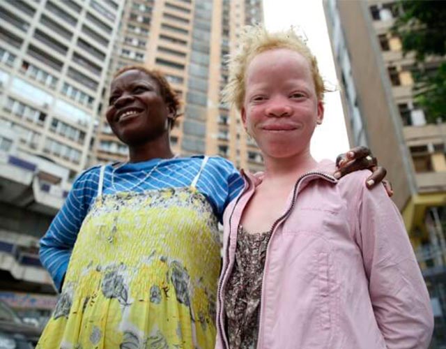Datos curiosos sobre los albinos