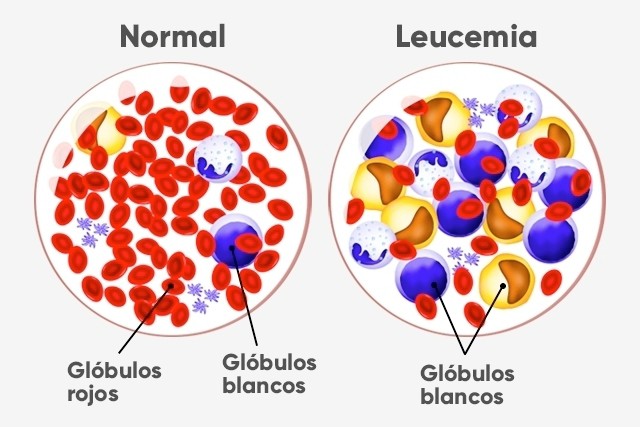 leucemia felina
