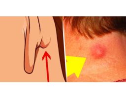 ¿Tienes un bulto en el cuello, espalda o detrás de la oreja? Ha causado la muerte a varios!