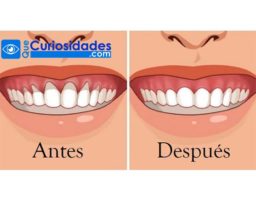 6 remedios naturales para combatir la retracción de las encías