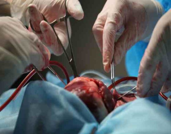 La primera operación de corazón para sustraer y colocar uno nuevo es un hecho histórico