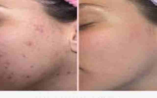 7 Causas del acné que no te dejan disfrutar de una piel hermosa y saludable