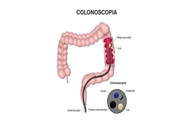 7 cosas que debes saber de una colonoscopia y la salud del colon...