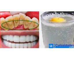 Retire El Sarro De Tus Dientes Con Este Tratamiento En Solo 3 Minutos