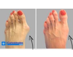 ¿Sufres de juanetes en los pies? Elimínalos de tu vida de forma natural y sin dolor